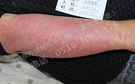 女性银屑病患者怀孕后银屑病的遗传几率有多少？