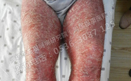 银屑病患者日常生活中怎样做可以提高身体素质？