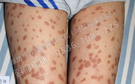 儿童银屑病患者日常生活怎样做才能早日摆脱银屑病的困扰？