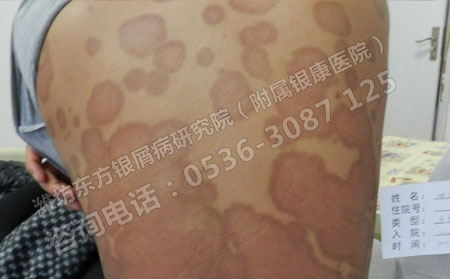 济南女性银屑病患者在治疗期间应该注意哪些问题？
