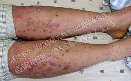 济南红皮型银屑病还能不能治疗好？