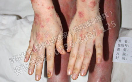 银屑病患者在治疗时应该注意避免哪些误区？