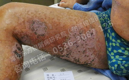 老年银屑病患者怎样做可以避免银屑病的侵袭？