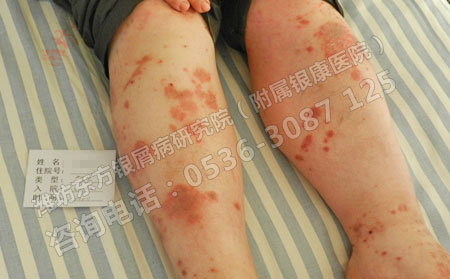 夏季银屑病患者如何从生活中预防银屑病复发？