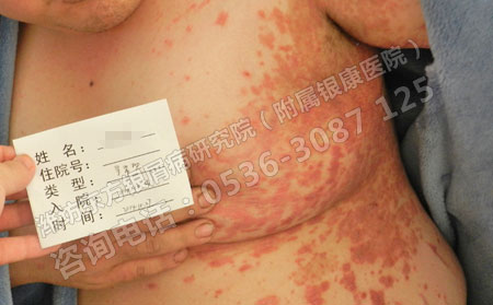 银屑病患者如何正确的使用药物治疗？