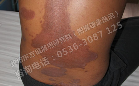 患者在济南牛皮癣医院进行药浴时需要注意的问题