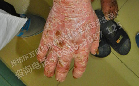 济南牛皮癣的治疗如何提高治疗效果