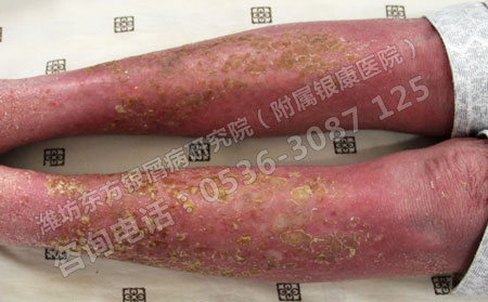 上班族注意了电脑辐射也会引起牛皮癣