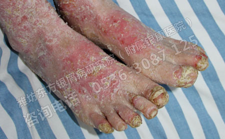 牛皮癣是怎么得上的