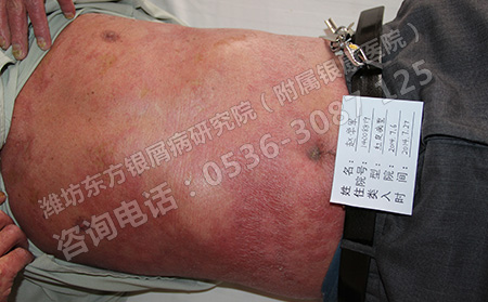 女性牛皮癣的诱发因素有哪些