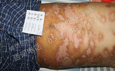 女性银屑病日常护理的要做好以下四个方面