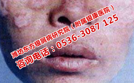脸上得了牛皮癣怎么治疗比较好