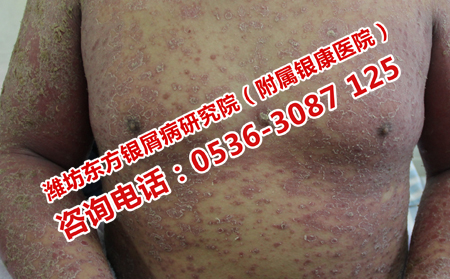 牛皮癣可以根治吗