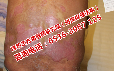 牛皮癣患者应该如何合理用药