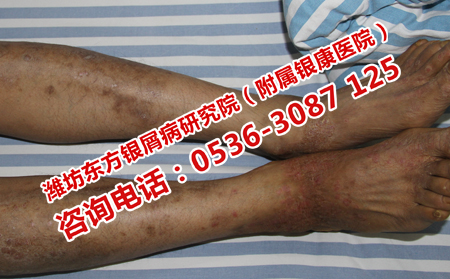 哪家医院可以治好牛皮癣呢