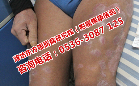 牛皮癣用什么药最有效