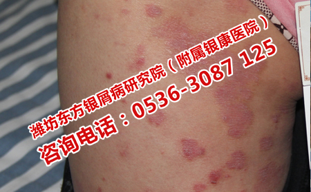 夏季牛皮癣护理需要注意哪些问题呢