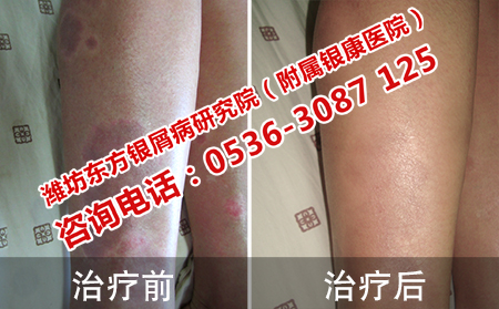 泡温泉对牛皮癣的康复有没有作用