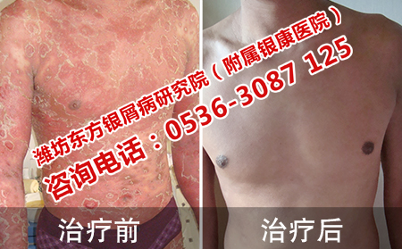 济南牛皮癣医院治疗牛皮癣效果怎样