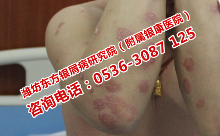 济南治疗牛皮癣最好的医院是哪家