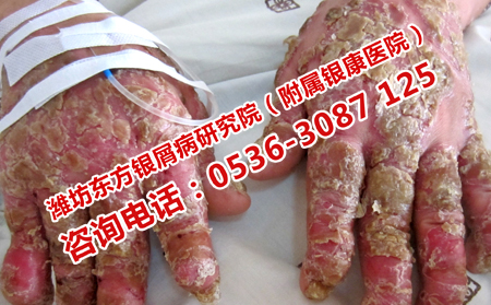 济南牛皮癣医院怎样治疗牛皮癣