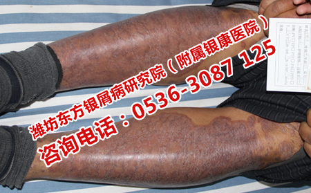 济南治疗牛皮癣最有效的医院在哪儿