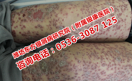 牛皮癣可以治好吗