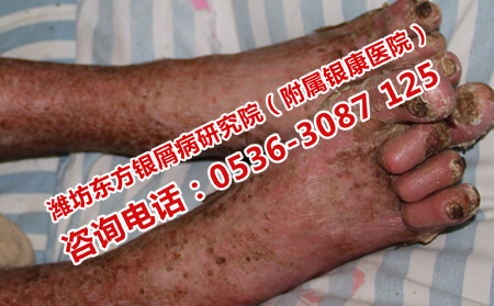 济南哪家银屑病医院最靠谱