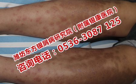 为什么会得牛皮癣