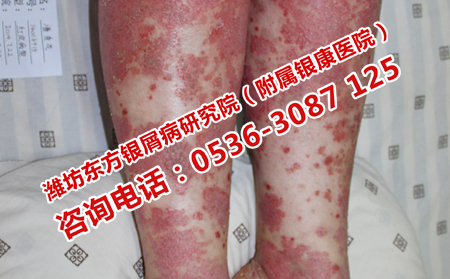关节型牛皮癣应该怎样治疗