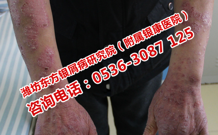 得了脓疱型牛皮癣应该怎样治疗