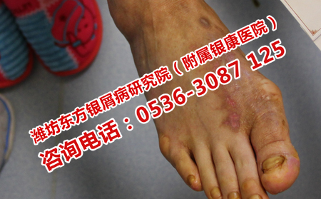 牛皮癣患者在日常应该注意什么问题
