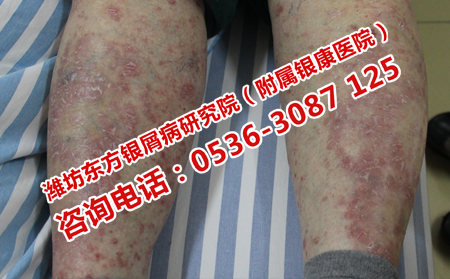 牛皮癣患者哪些食物不能吃