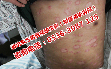 牛皮癣患者在日常吃点什么比较好
