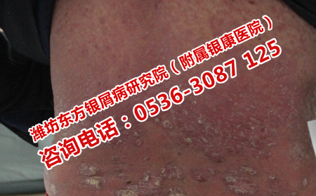 牛皮癣患者在日常吃点什么比较好