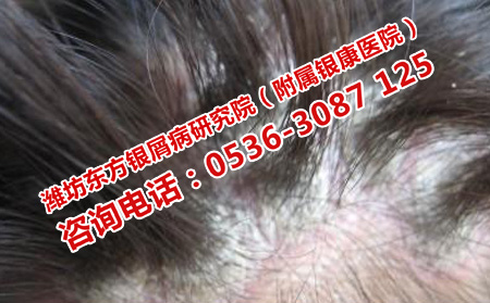 头上得了牛皮癣应该怎样洗头