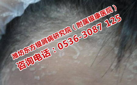 寻常型牛皮癣患者吃点什么比较好