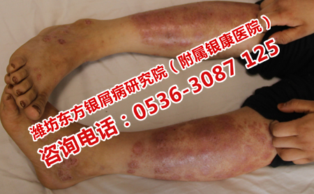 偏方治疗牛皮癣有效吗