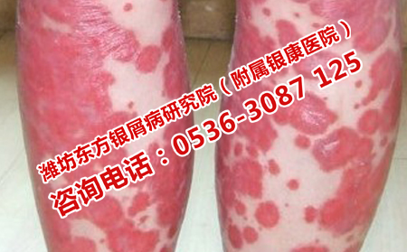牛皮癣患者在日常需要注意什么问题