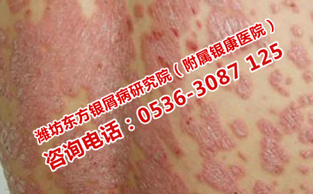 治疗牛皮癣最重要的是什么