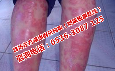 怎样才能治好牛皮癣