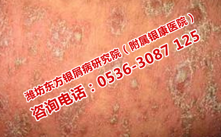 牛皮癣治疗好的药物是什么