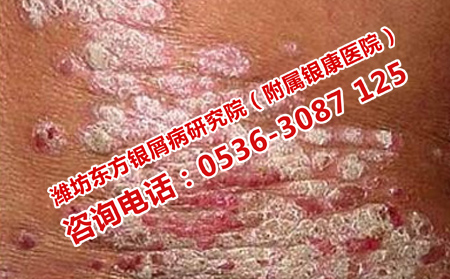 诱发儿童牛皮癣的原因是什么