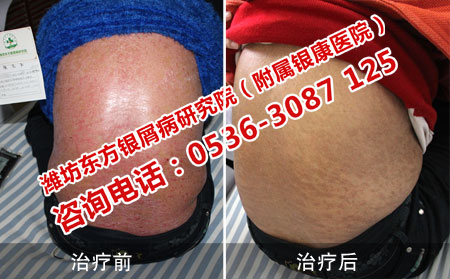 半辈子的牛皮癣终于治好了