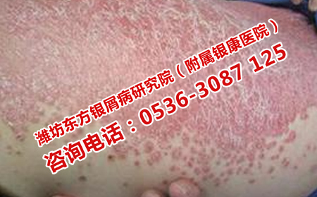 中医治济南牛皮癣患者更好