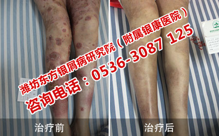 乱用药物导致的腿部牛皮癣康复了