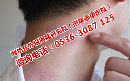 济南治疗牛皮癣首选哪家医院