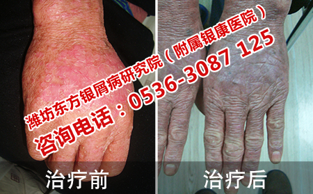 治好奶奶手部的银屑病