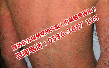 中西医治疗牛皮癣比较