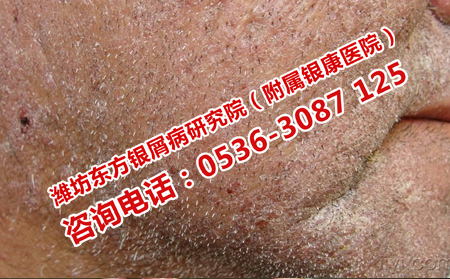 银屑病治多久能好